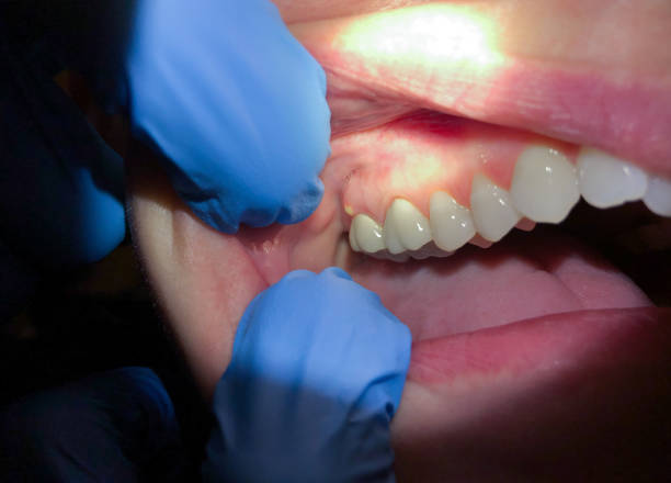 Best Broken or Cracked Tooth Emergency Dentist in North Puyallup, WA